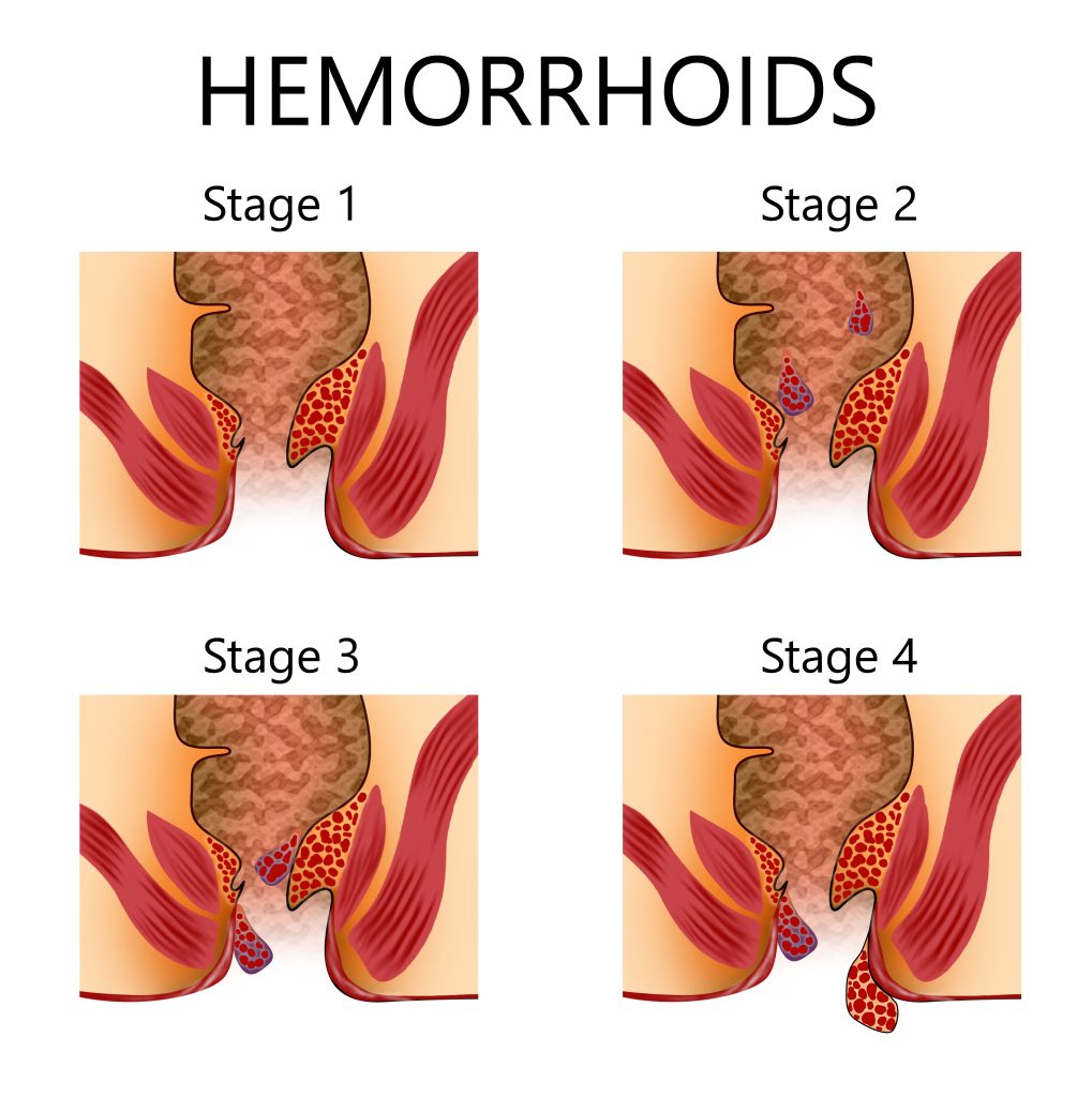 stage ii hemorrhoids internal